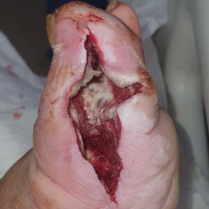 Hallux Phalanx Resection with Soft-Tissue Preservation procedure image