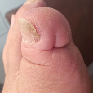 Hallux Phalanx Resection with Soft-Tissue Preservation outcome image