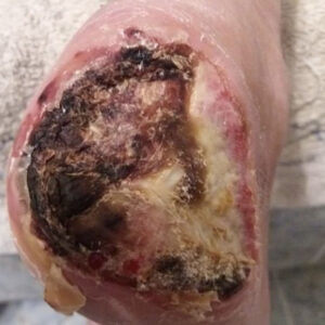 Heel-Sparing Partial Calcanectomy After Revascularization before image