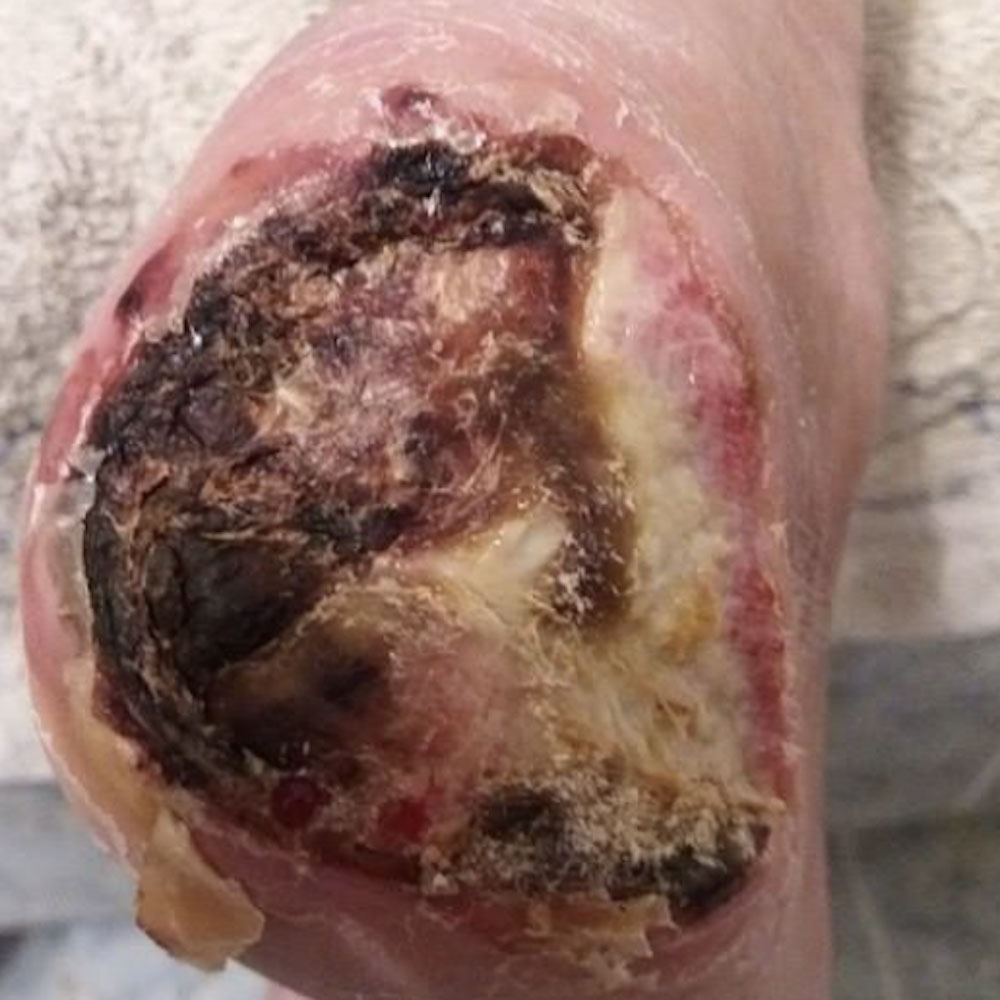 Heel-Sparing Partial Calcanectomy After Revascularization before image