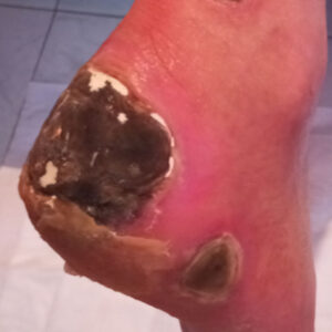 Heel-Sparing Partial Calcanectomy After Revascularization before image