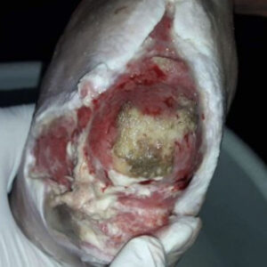 Heel-Sparing Partial Calcanectomy After Revascularization procedure image