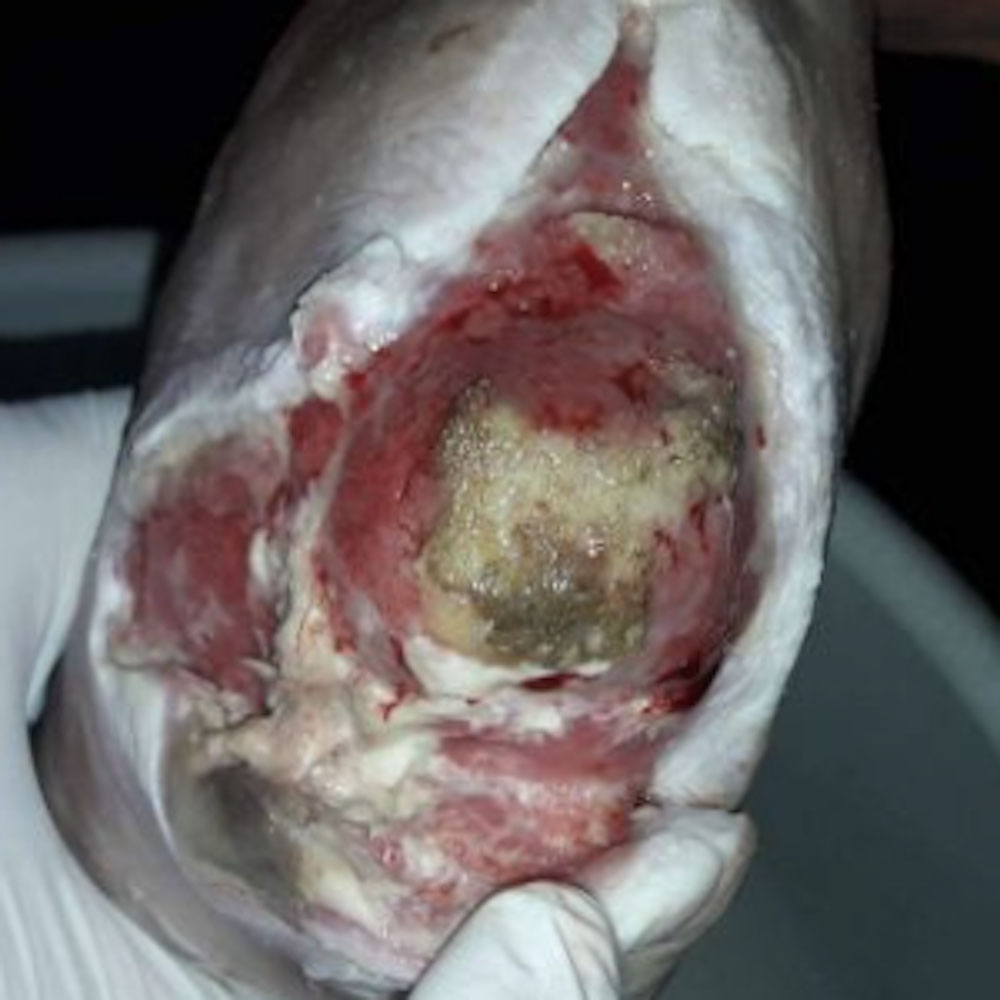 Heel-Sparing Partial Calcanectomy After Revascularization procedure image
