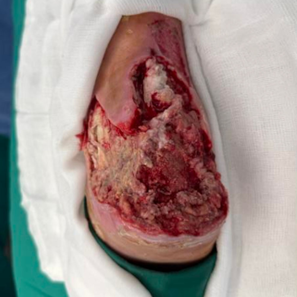 Heel-Sparing Partial Calcanectomy After Revascularization procedure image