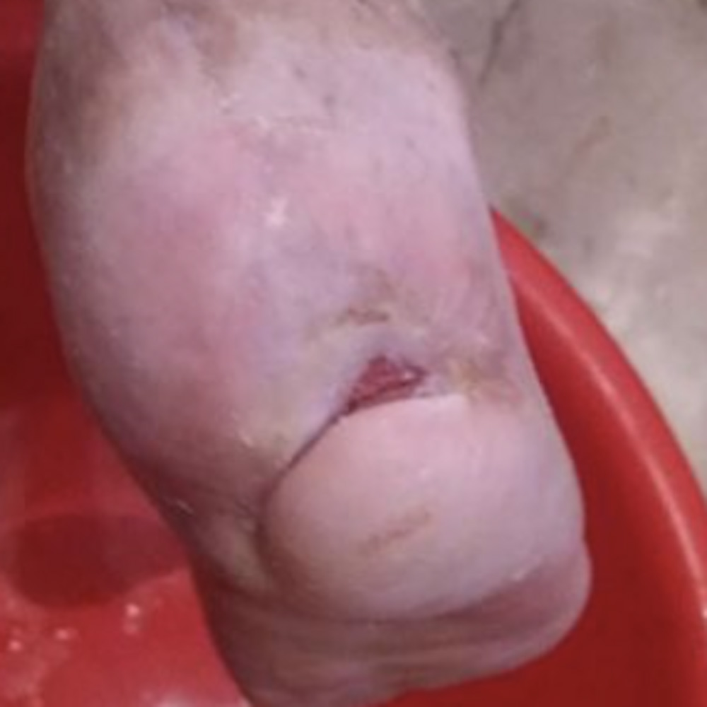Heel-Sparing Partial Calcanectomy After Revascularization outcome image