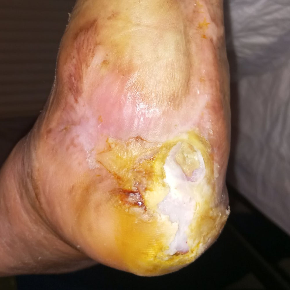 Heel-Sparing Partial Calcanectomy After Revascularization outcome image