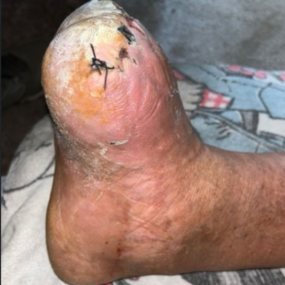 Lisfranc Amputation Following Successful Revascularization procedure image