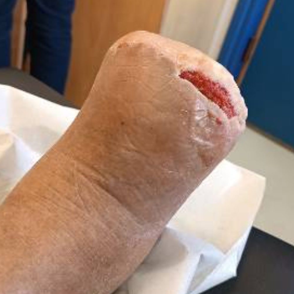Lisfranc Amputation Following Successful Revascularization outcome image