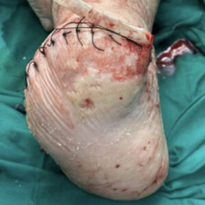 Lisfranc Amputation for Extensive Forefoot Ischemic Gangrene before image