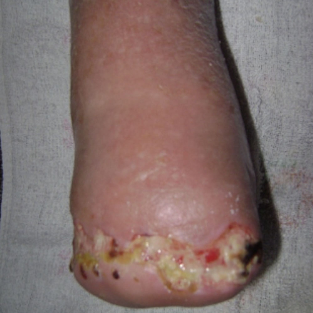 Lisfranc Amputation for Extensive Forefoot Ischemic Gangrene procedure image
