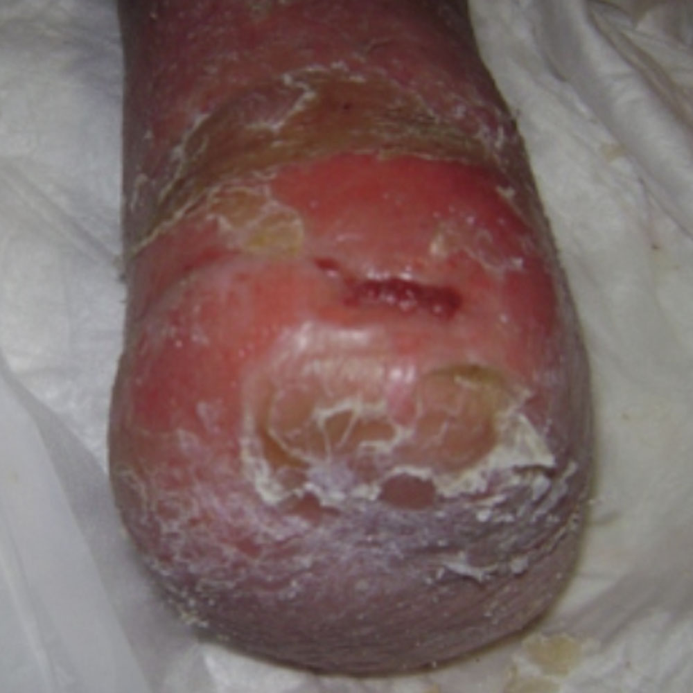 Lisfranc Amputation for Extensive Forefoot Ischemic Gangrene outcome image