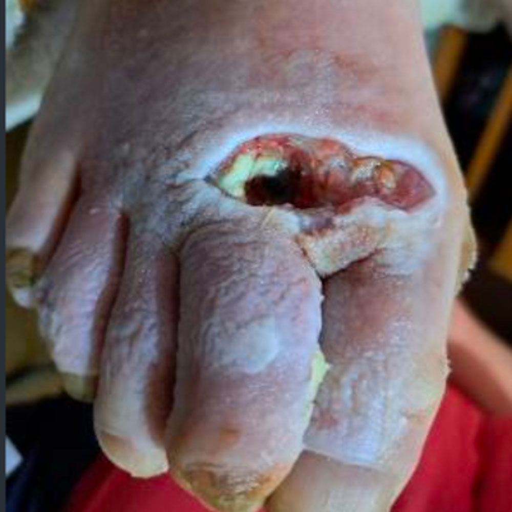 Lisfranc Amputation for Extensive Forefoot Osteomyelitis before image