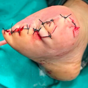 Lisfranc Amputation for Extensive Forefoot Osteomyelitis procedure image
