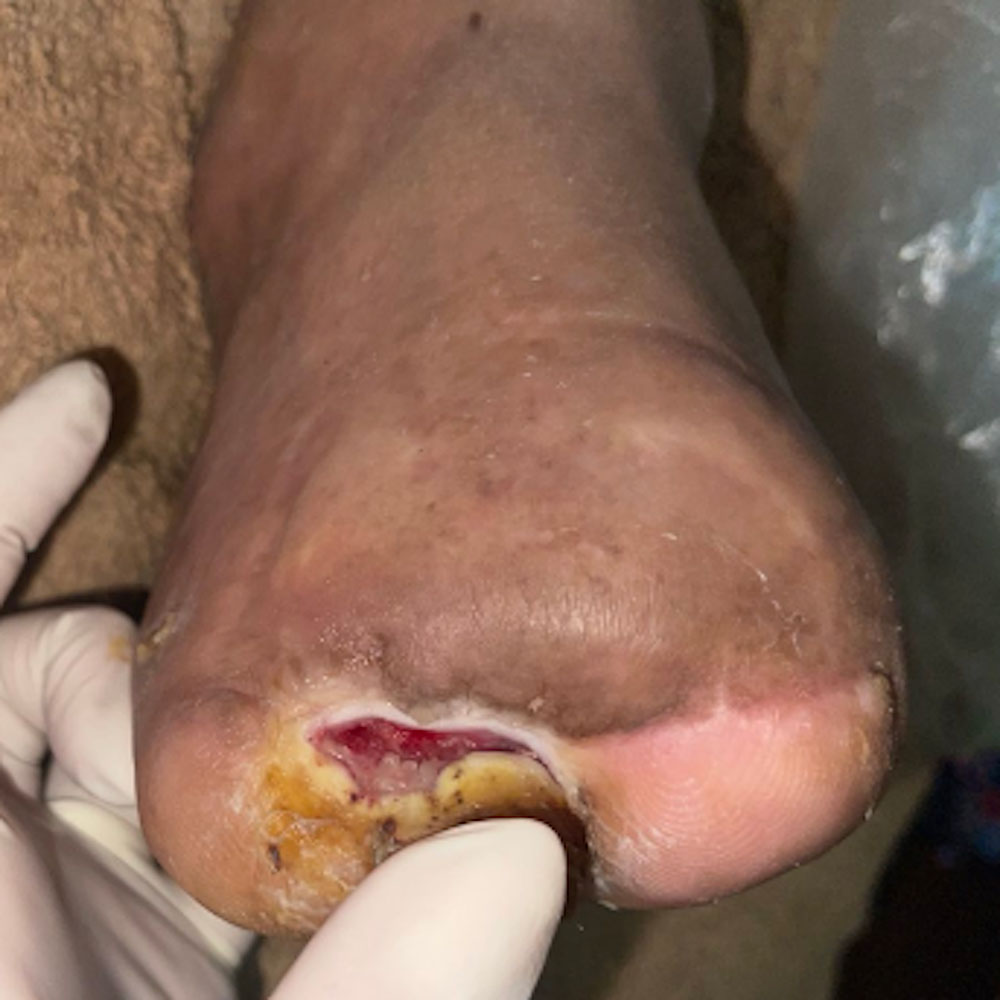 Lisfranc Amputation for Extensive Forefoot Osteomyelitis outcome image