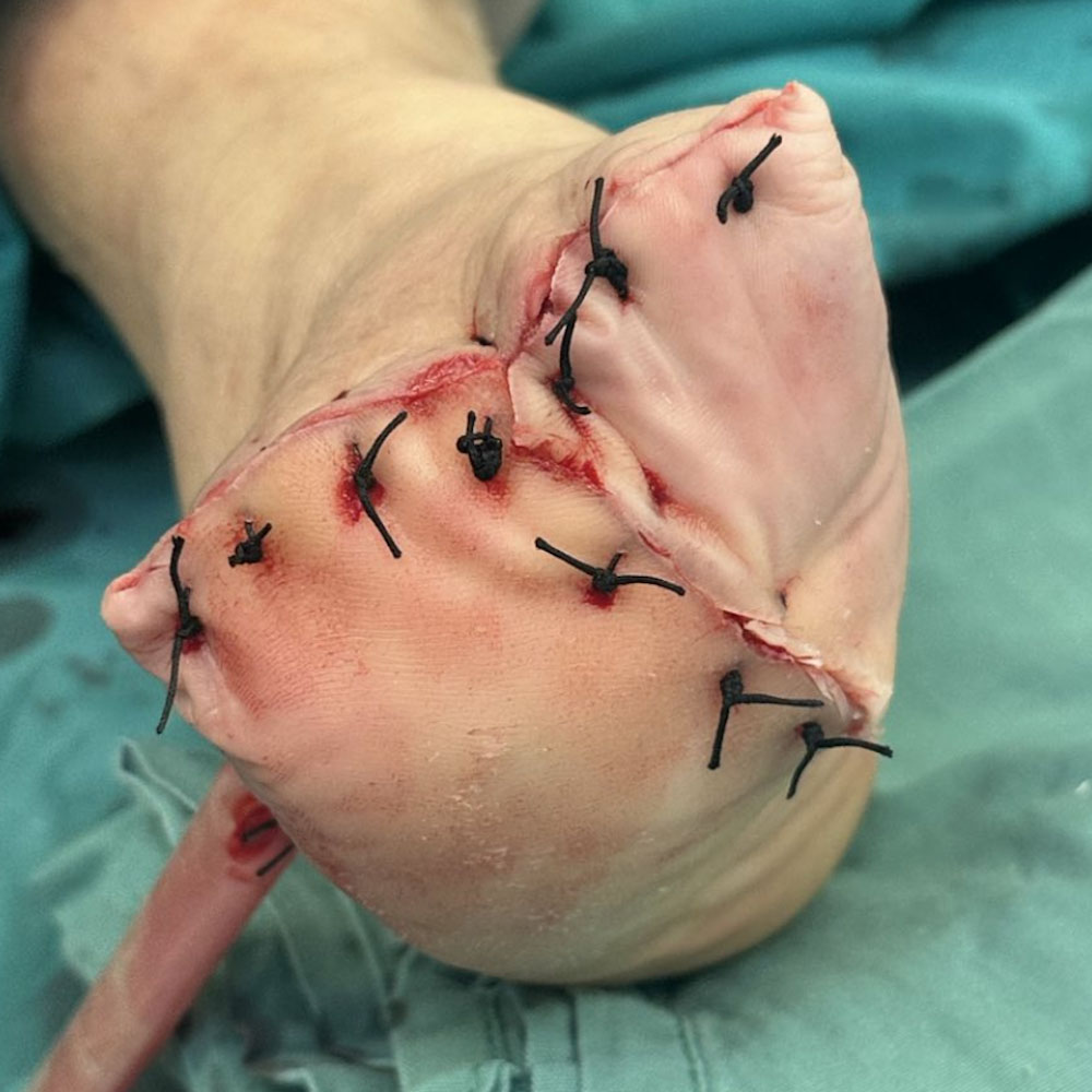 Lisfranc Amputation for Extensive Metatarsal Osteomyelitis before image