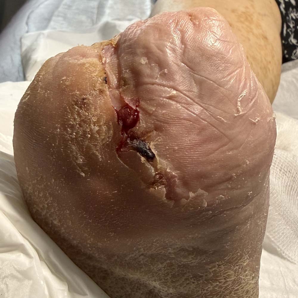 Lisfranc Amputation for Extensive Metatarsal Osteomyelitis procedure image