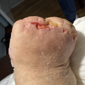 Lisfranc Amputation for Extensive Metatarsal Osteomyelitis outcome image