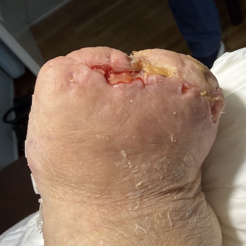 Lisfranc Amputation for Extensive Metatarsal Osteomyelitis outcome image