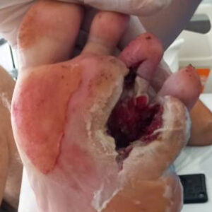 Metatarsal Resection for Recurrent Diabetic Foot Osteomyelitis before image