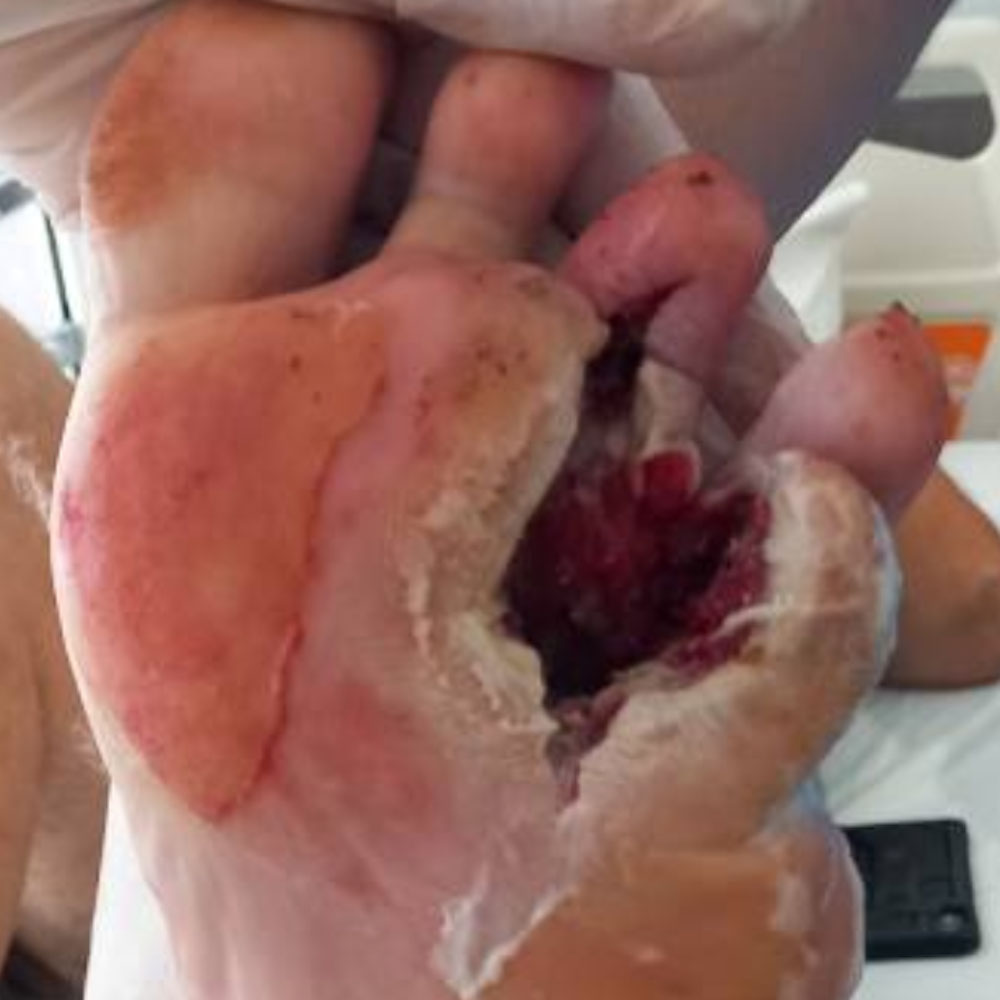 Metatarsal Resection for Recurrent Diabetic Foot Osteomyelitis before image