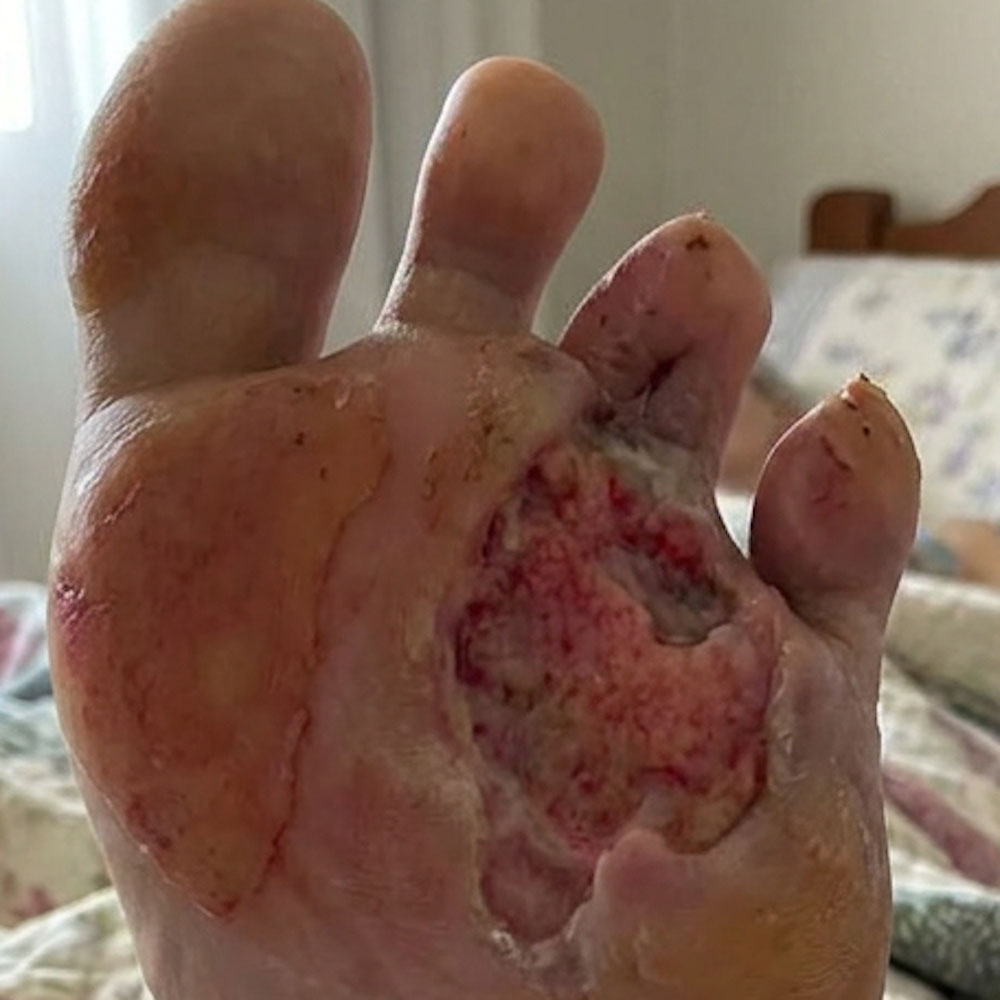 Metatarsal Resection for Recurrent Diabetic Foot Osteomyelitis procedure image