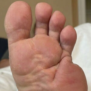 Metatarsal Resection for Recurrent Diabetic Foot Osteomyelitis outcome image