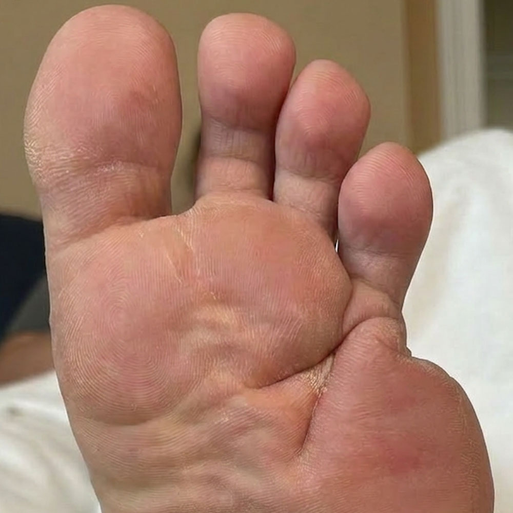 Metatarsal Resection for Recurrent Diabetic Foot Osteomyelitis outcome image