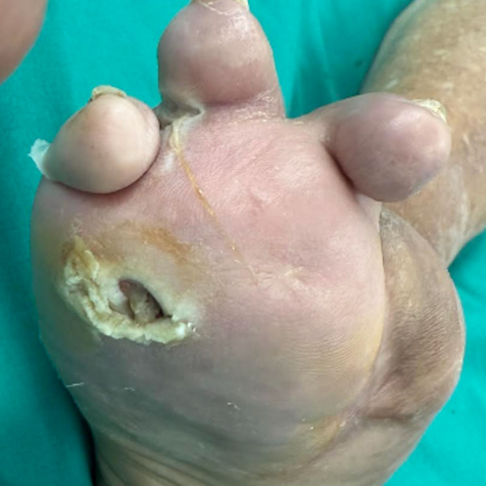 Open Lisfranc Amputation for Extensive Forefoot Osteomyelitis before image