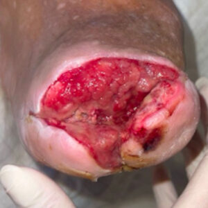 Open Lisfranc Amputation for Extensive Forefoot Osteomyelitis procedure image