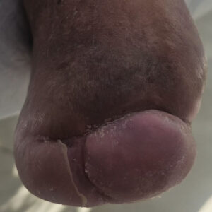 Open Lisfranc Amputation for Extensive Forefoot Osteomyelitis outcome image