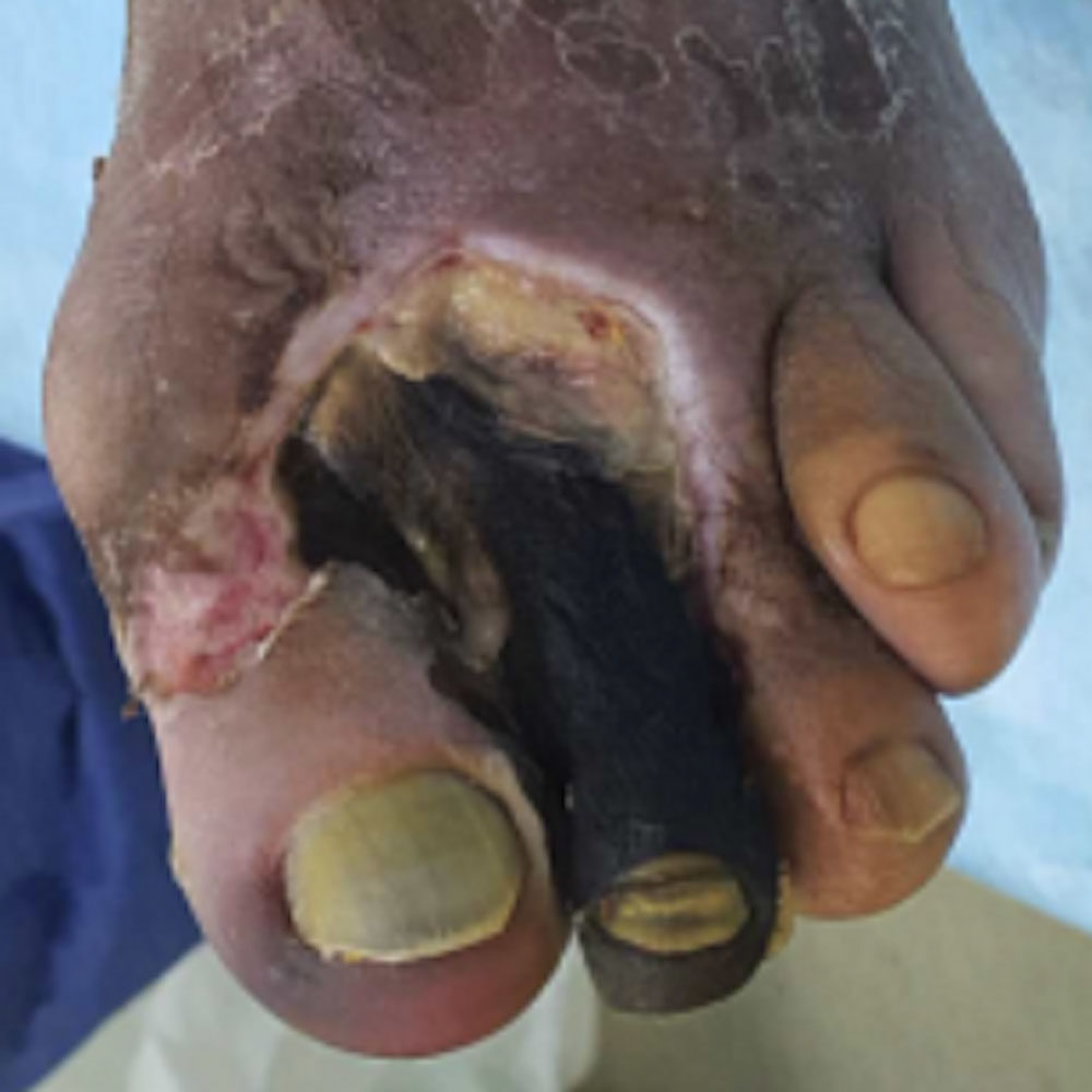 Partial Forefoot Amputation Following Revascularization before image