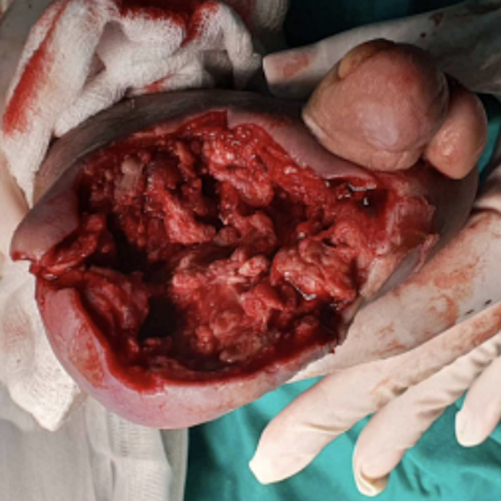 Partial Forefoot Amputation Following Revascularization procedure image