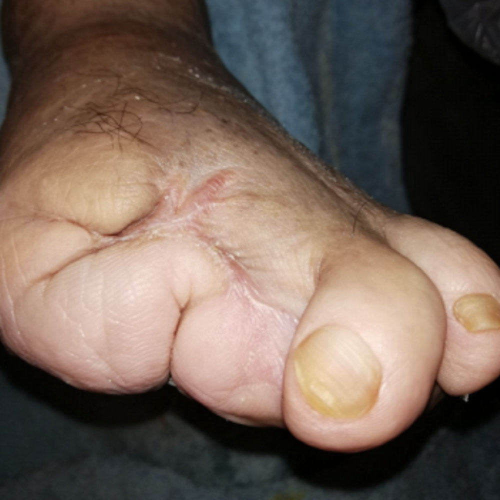 Partial Forefoot Amputation Following Revascularization outcome image