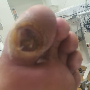 Plantar Hallux Osteomyelitis Treated with Toe Preservation before image