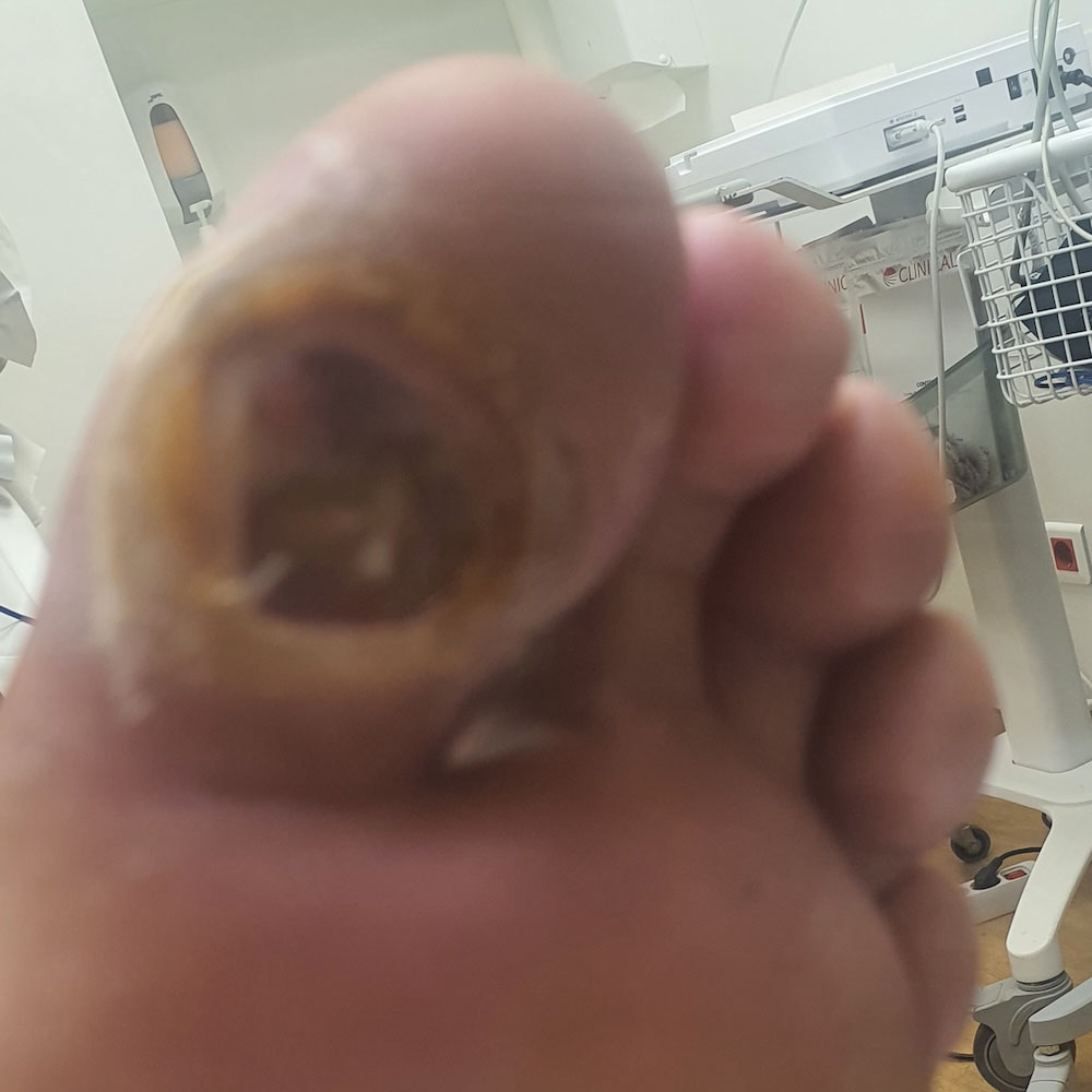 Plantar Hallux Osteomyelitis Treated with Toe Preservation before image