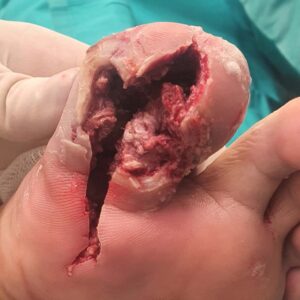 Plantar Hallux Osteomyelitis Treated with Toe Preservation procedure image