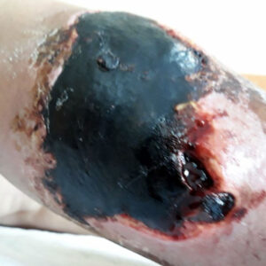 Post-Traumatic Pretibial Necrosis Following Neglected Hematoma before image