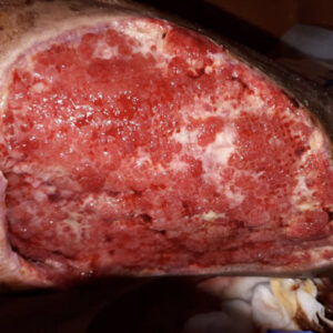 Post-Traumatic Pretibial Necrosis Following Neglected Hematoma procedure image