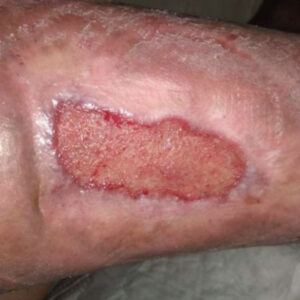 Post-Traumatic Pretibial Necrosis Following Neglected Hematoma outcome image