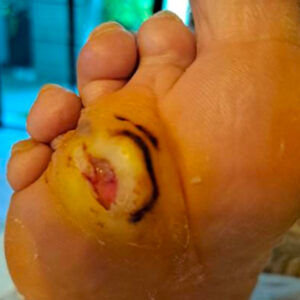 Repeat Limb-Sparing Surgery for Recurrent Metatarsal Osteomyelitis before image