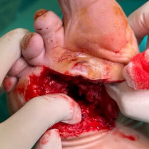 Repeat Limb-Sparing Surgery for Recurrent Metatarsal Osteomyelitis procedure image