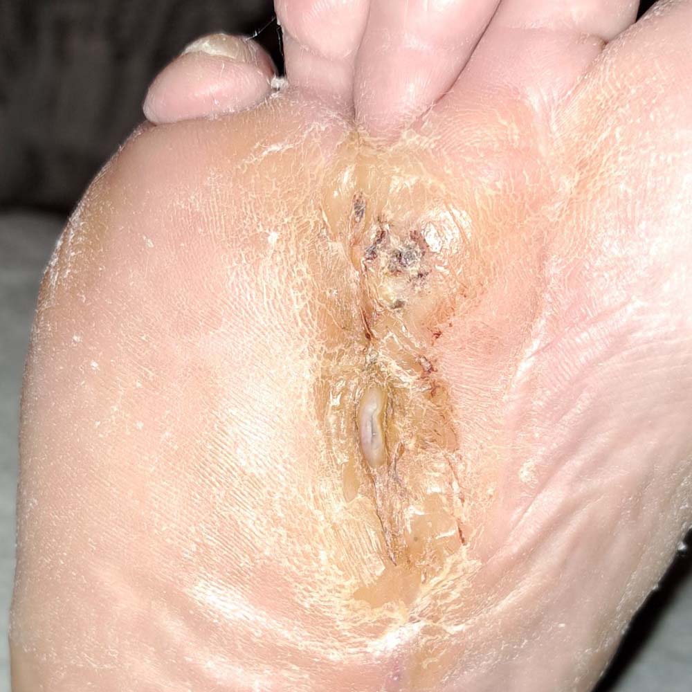 Repeat Limb-Sparing Surgery for Recurrent Metatarsal Osteomyelitis outcome image