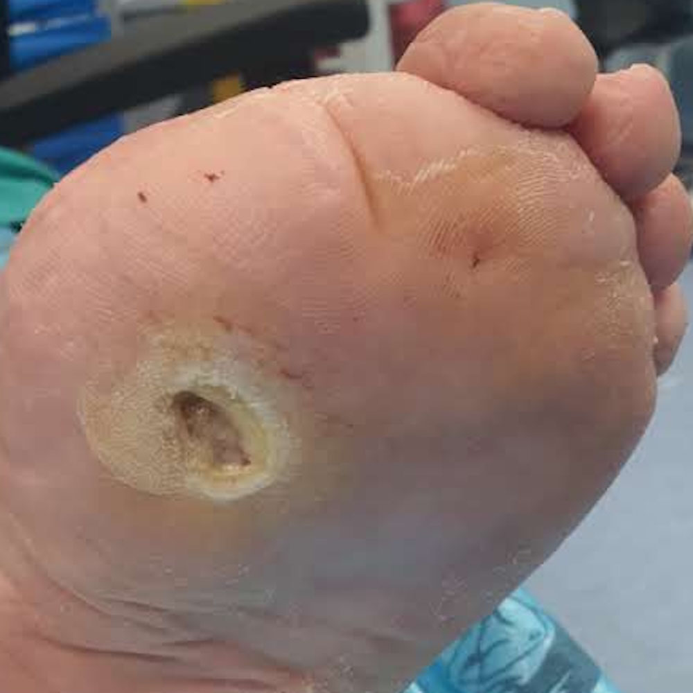 Residual First Metatarsal Osteomyelitis After Previous Surgery before image