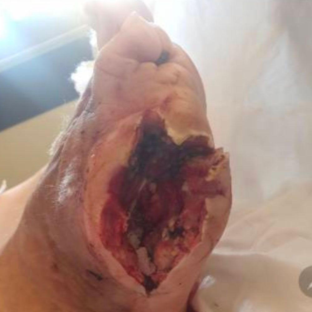 Residual First Metatarsal Osteomyelitis After Previous Surgery procedure image