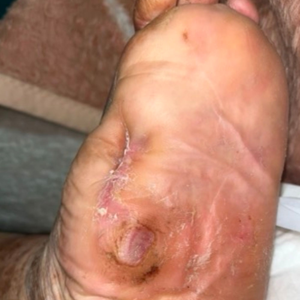 Residual First Metatarsal Osteomyelitis After Previous Surgery outcome image