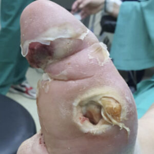 Salvage of the Last Remaining Ray Following Previous Partial Foot Amputation before image