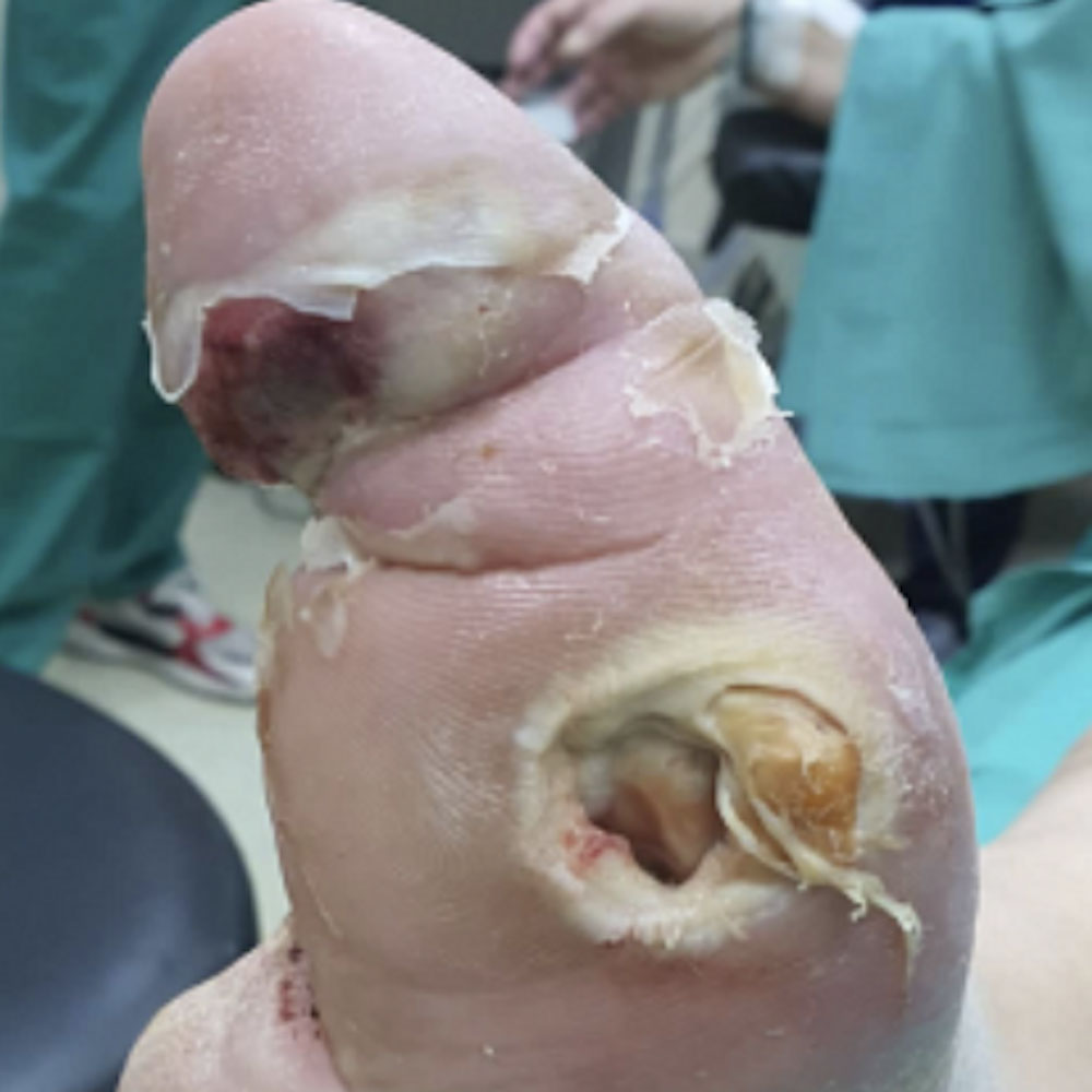 Salvage of the Last Remaining Ray Following Previous Partial Foot Amputation before image