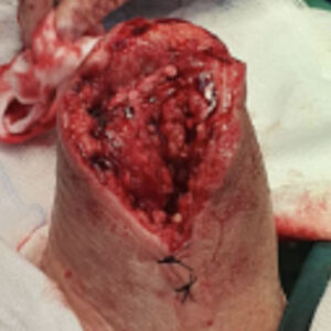 Salvage of the Last Remaining Ray Following Previous Partial Foot Amputation procedure image