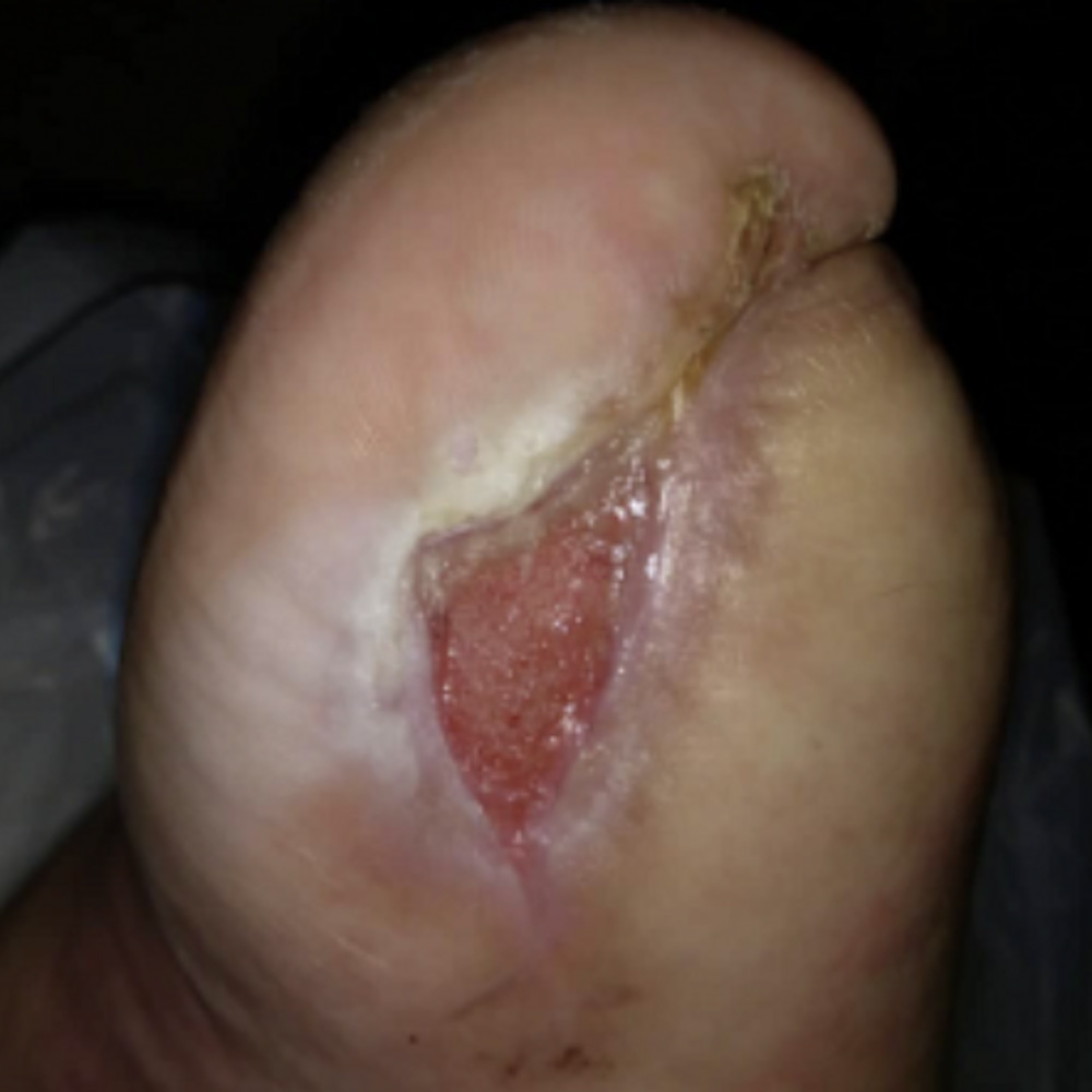 Salvage of the Last Remaining Ray Following Previous Partial Foot Amputation outcome image