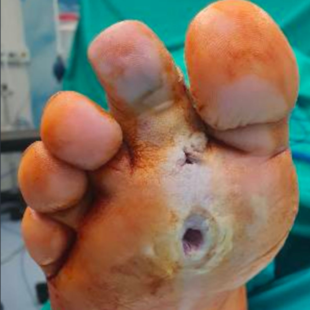 Second Ray Resection for Extensive Diabetic Foot Osteomyelitis before image